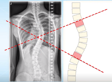 脊柱側(cè)彎的角度測(cè)量